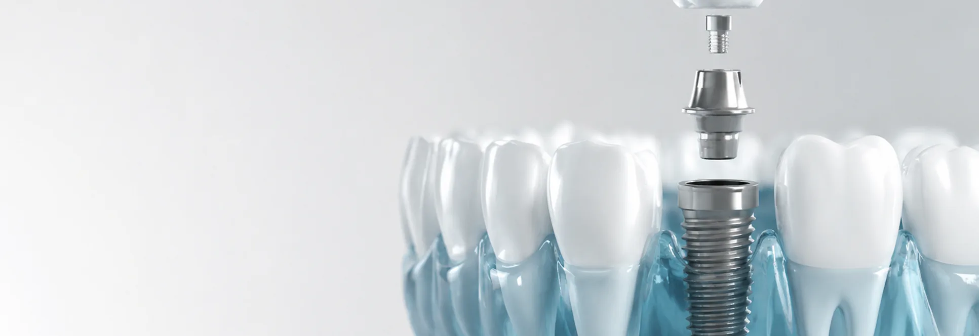 Computer guided dental implants at Southern Pines Family Dental